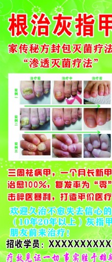 灰指甲海报图片免费下载,灰指甲海报设计素材大全,灰指甲海报模板下载